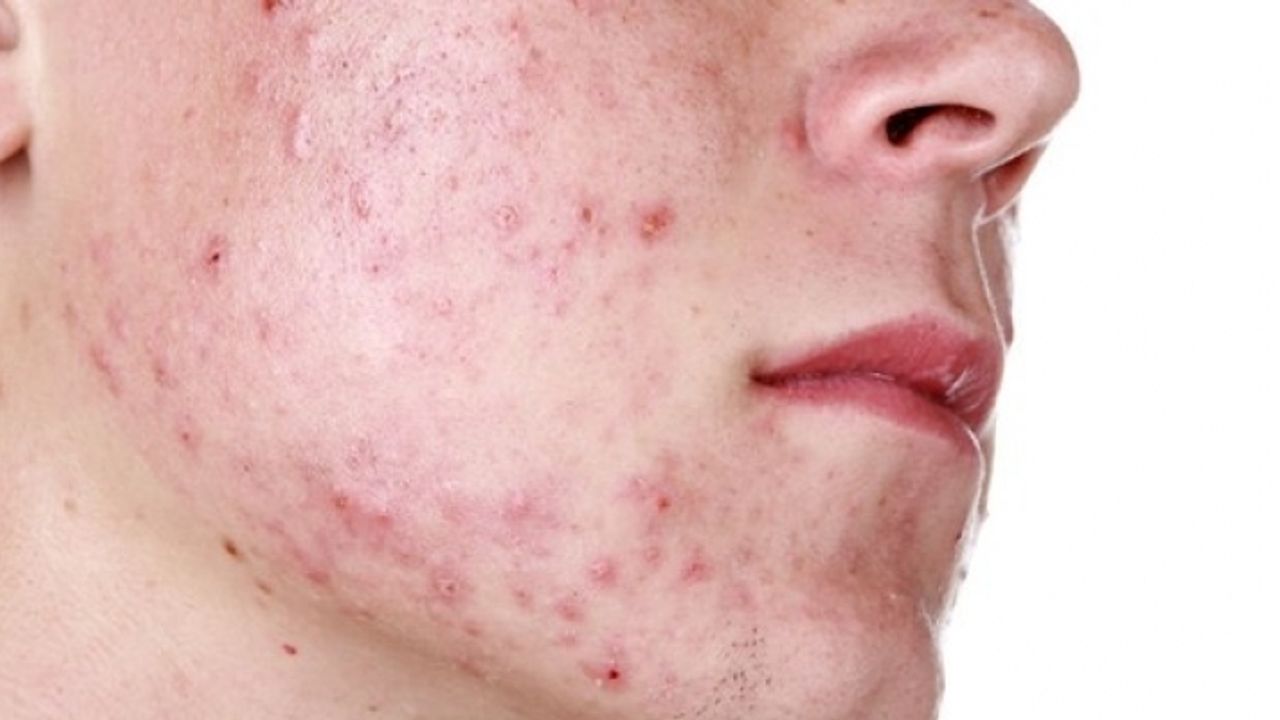 Sivilce ve aknenin sebebi yanlış beslenme mi?