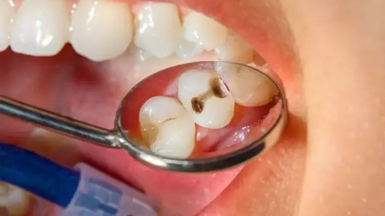 Uzmanı uyarıyor: Çürük süt dişleri sürekli dişleri de çürütüyor, 6 yaşından önce önlemini alın