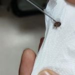 Çocuğun kulağından canlı kene çıkarıldı