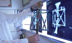 Boy kısalığına karşı modern çözüm: kemik uzatma yöntemleri