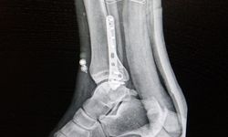 Ortopedi uzmanı tehlikeye karşı uyardı