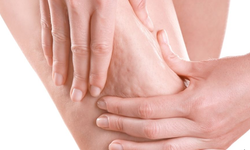 Selülit bir görüntü kusuru değil, vücudun imdat çığlığı!