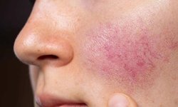Yüzünüzdeki kızarıklığı hafife almayın