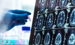 'Alzheimer düşünüldüğünden daha erken başlayabilir'