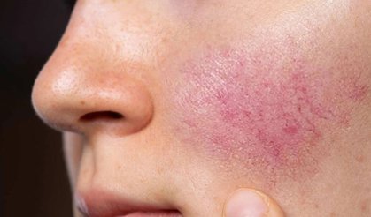 Yüzünüzdeki kızarıklığı hafife almayın
