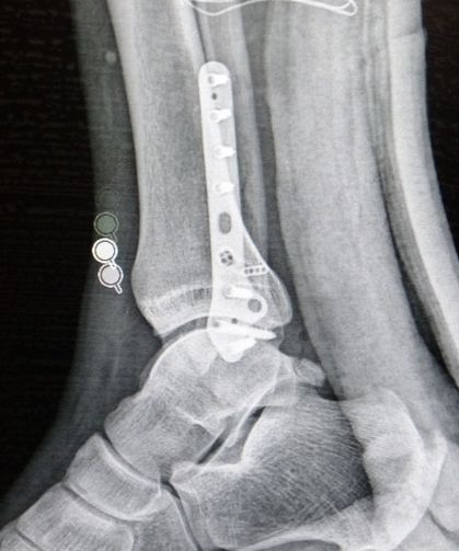 Ortopedi uzmanı tehlikeye karşı uyardı