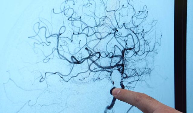 ‘Beyin anevrizması her 20 kişiden birinde görülebilir’