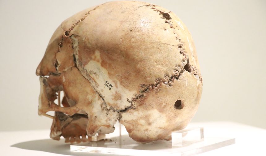 Dünyanın ilk beyin ameliyatına ait kafatası