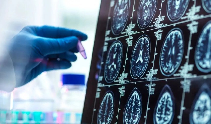 'Alzheimer düşünüldüğünden daha erken başlayabilir'