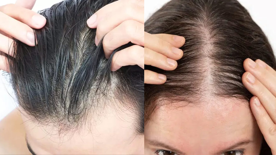 Hair Loss In Women Causes Types Treatment And Solution 4